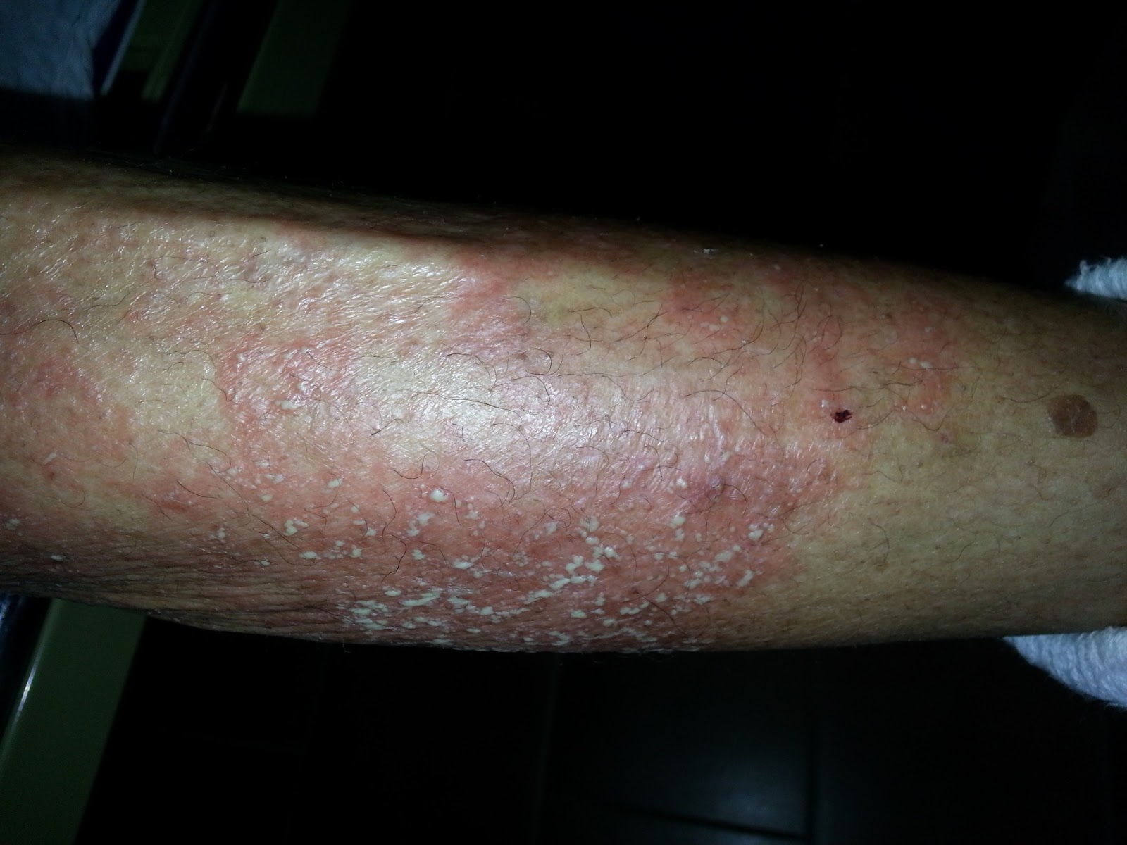 La psoriasis los resultados de los análisis